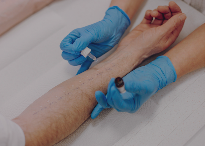 Ein Allergietest wird an einem Patienten durchgeführt, bei dem mehrere Allergene auf der Haut getestet und die Reaktionen beobachtet werden.